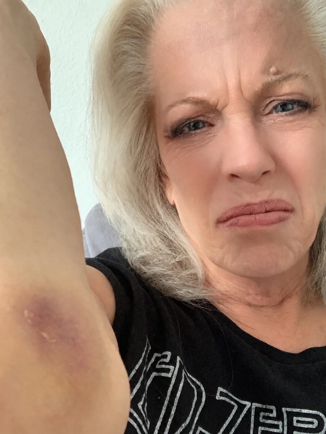 A ferocious close-up of Pinkerton showing a bruise near her elbow after floor-work dance class